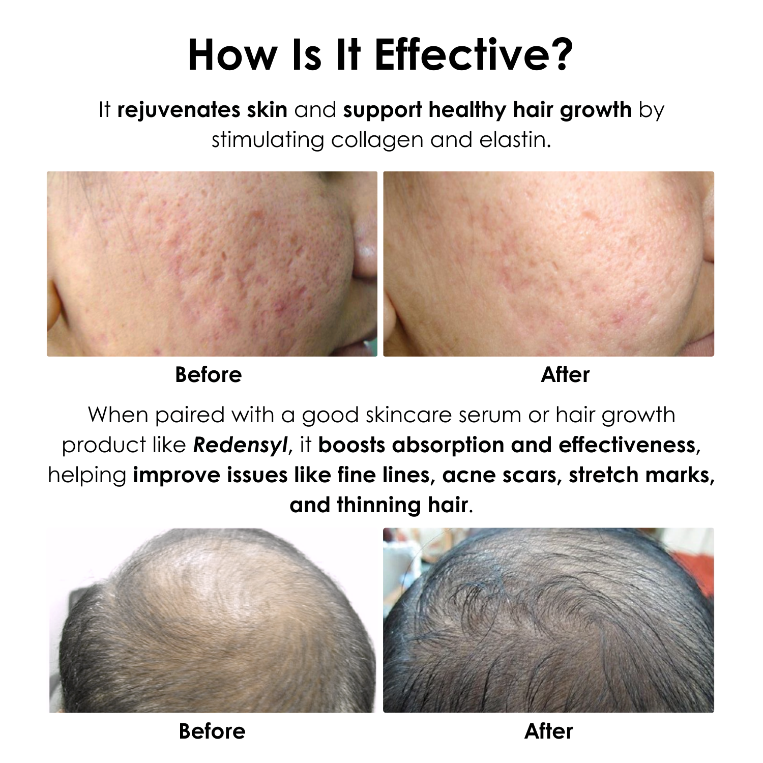 Apestomen Derma Roller Medical-Grade 540-Pin Titanium Derma Roller Mirconeedling Skin Rejuvenation & Beard, Hair Growth
